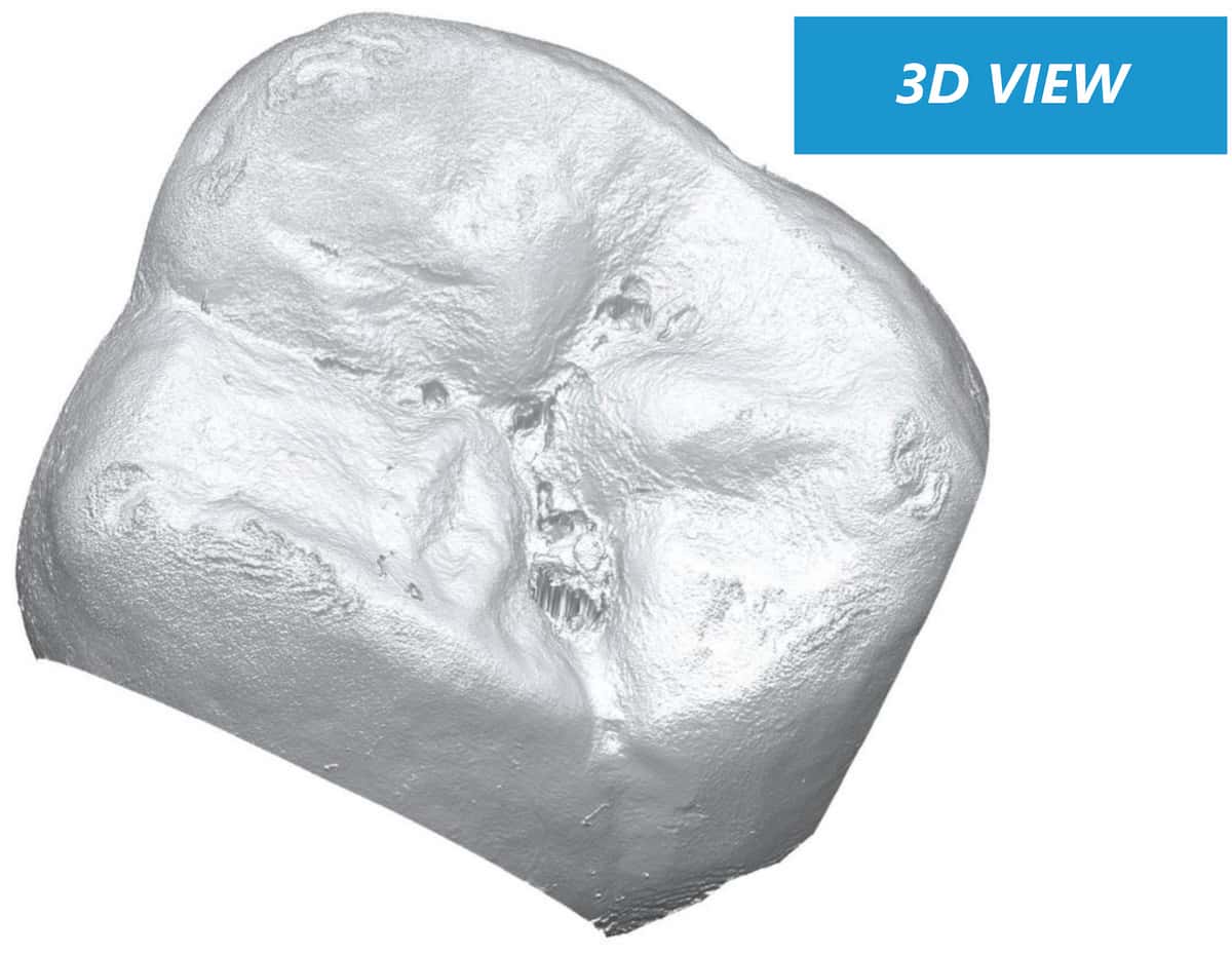 3D surface reconstruction of molar crown from optical profilometer scan
