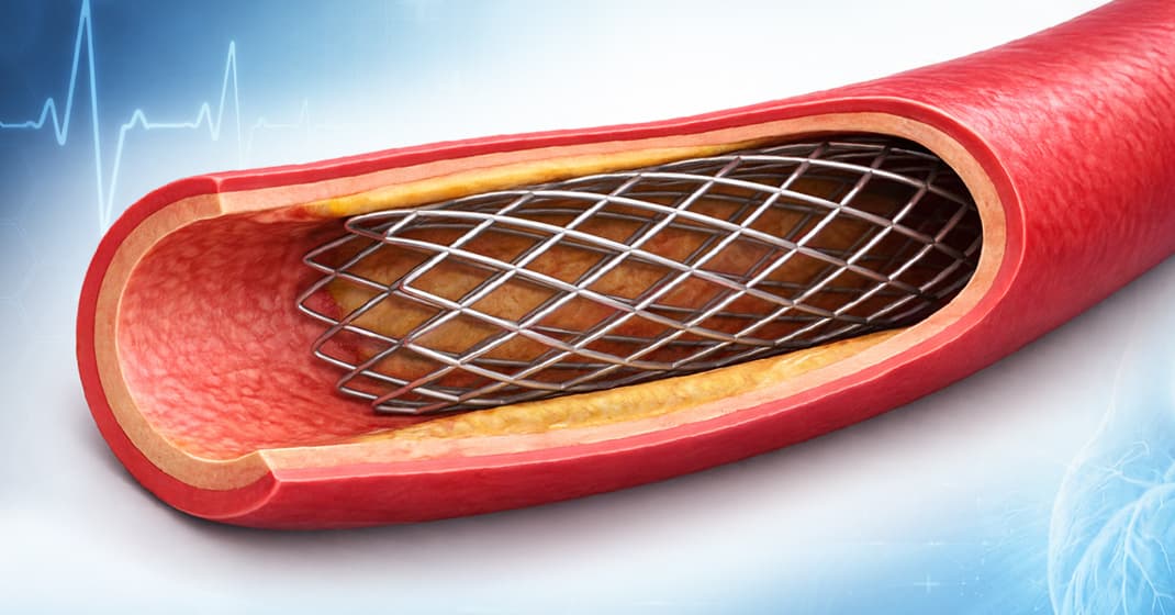 stent coating adhesion testing failure analysis drug eluting stent coating
