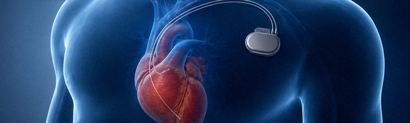 Medical illustration of a pacemaker with two endocardial pacing leads routed into the heart for pacing lead insulation wear testing context