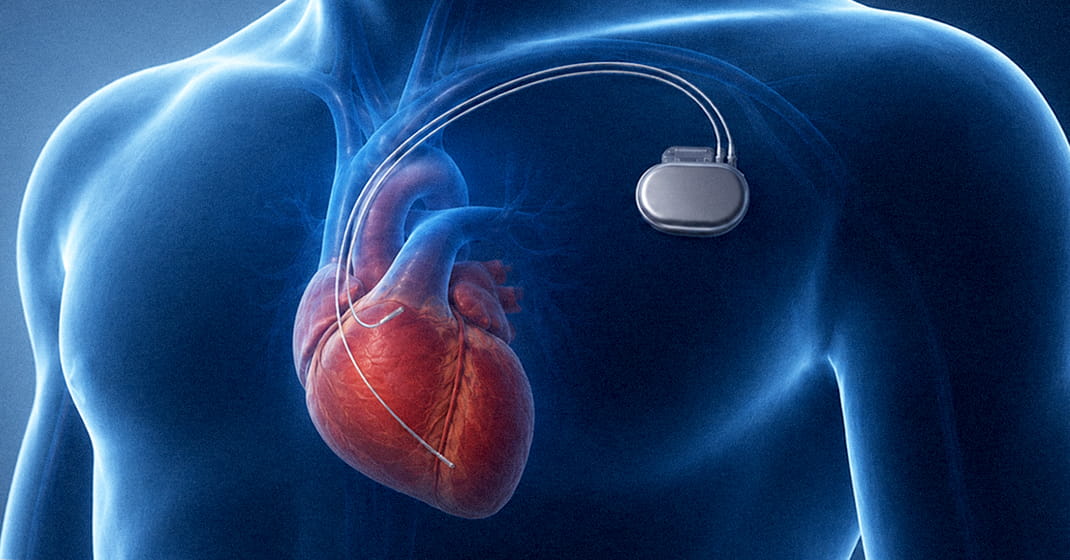 Pacemaker and endocardial pacing leads shown in a translucent medical illustration for pacing lead insulation wear testing
